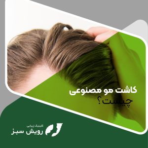 Read more about the article کاشت مو مصنوعی چیست؟