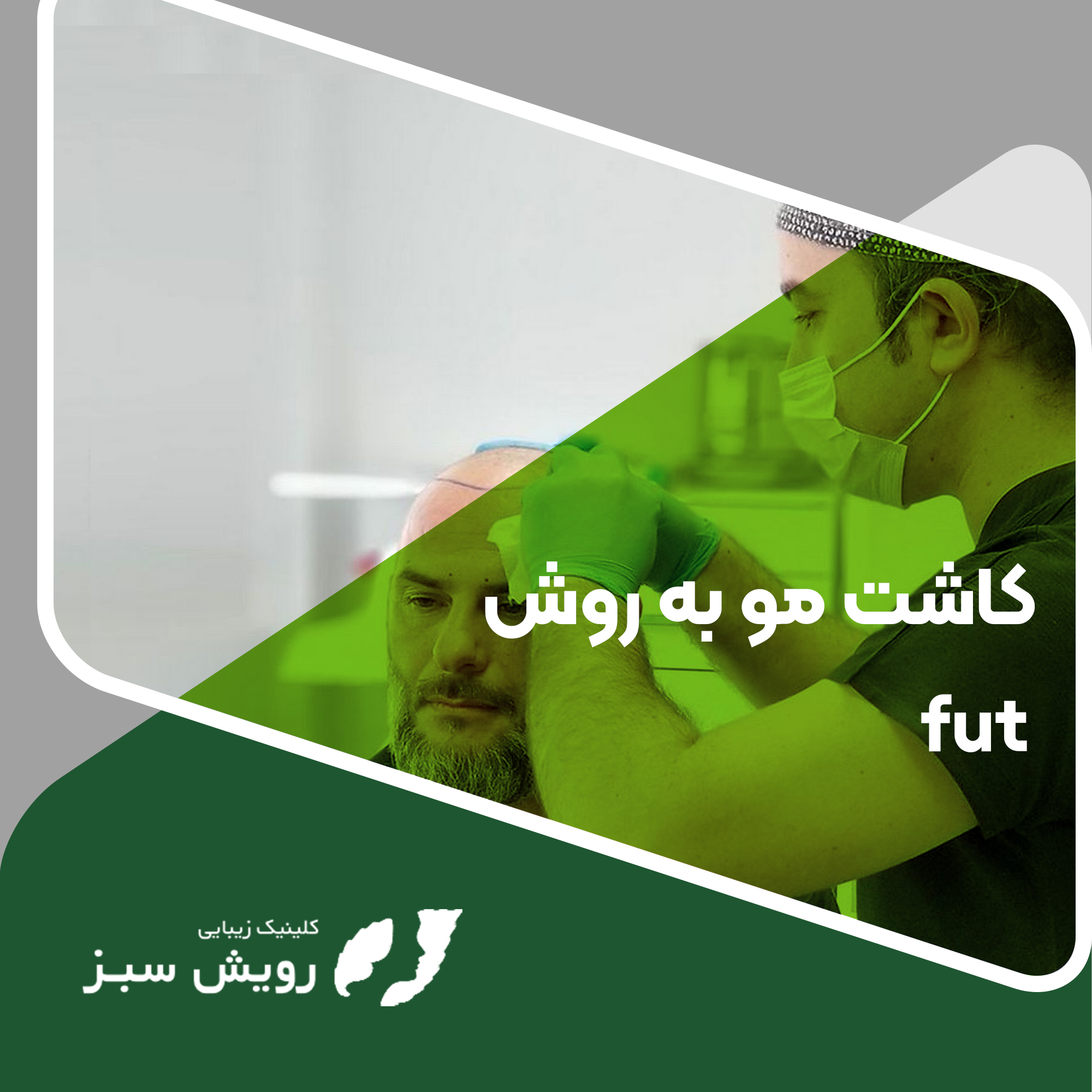You are currently viewing کاشت مو به روش fut
