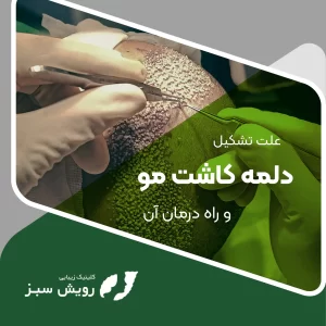 Read more about the article علت تشکیل دلمه کاشت مو و راه درمان آن
