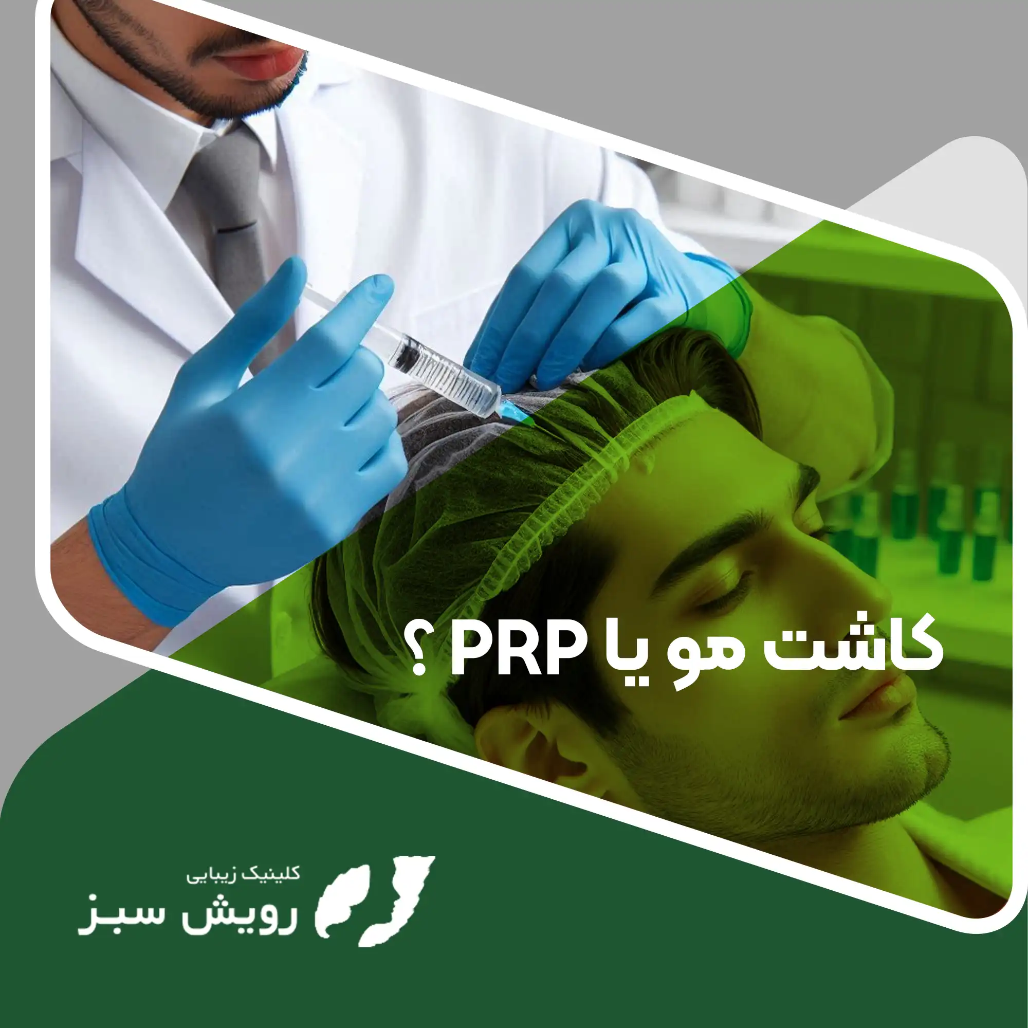 You are currently viewing کاشت مو بهتر است یا PRP؟ کدام روش برای درمان طاسی مناسب است؟