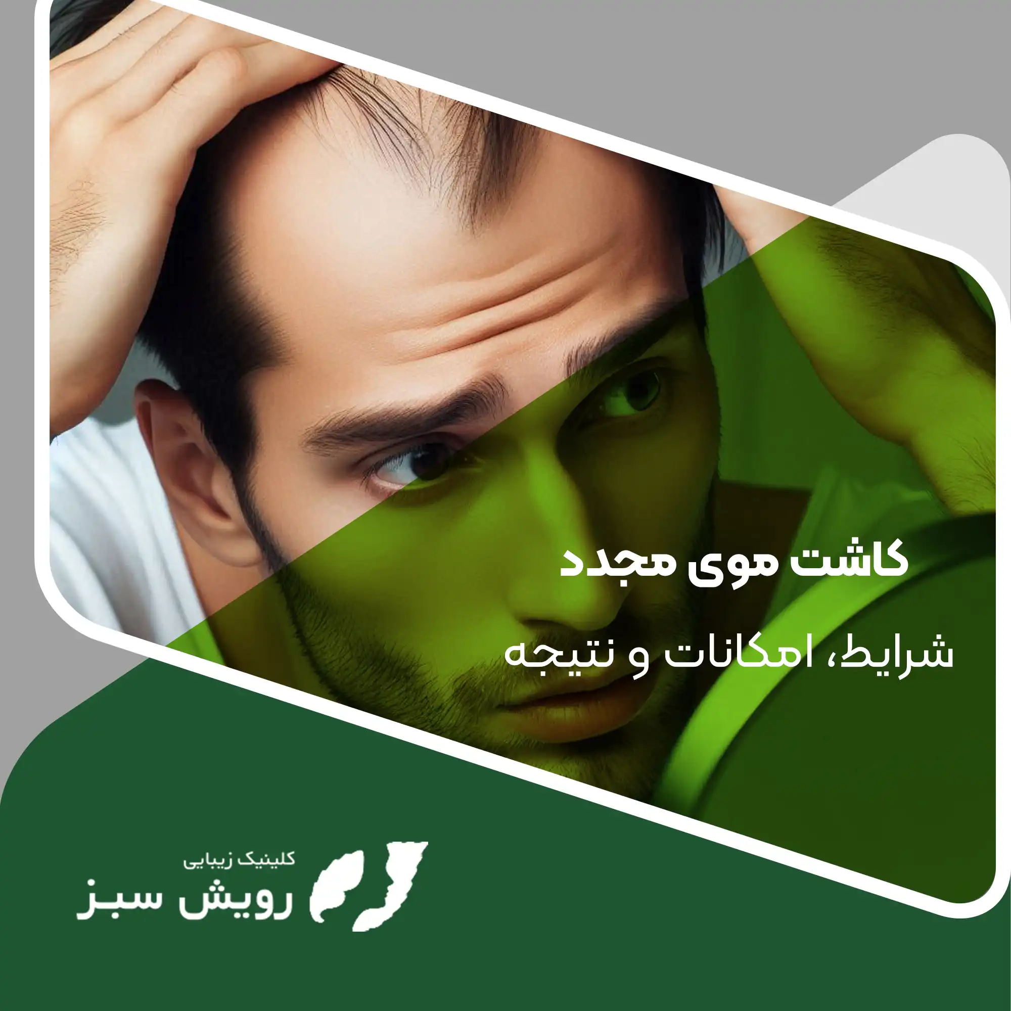 You are currently viewing کاشت موی مجدد و متعدد – تا چند بار میتوان کاشت مو انجام داد؟