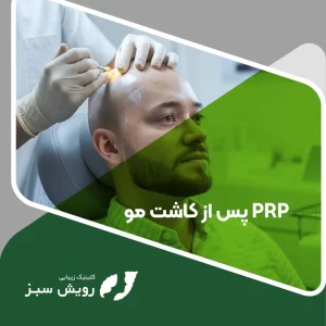 Read more about the article آیا PRP پس از کاشت مو مناسب است؟