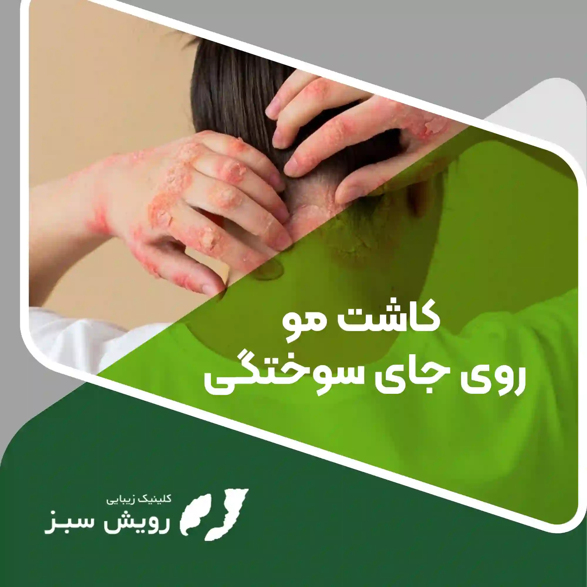 Read more about the article کاشت مو برای افرادی که دچار سوختگی شده‌اند به چه صورت است؟