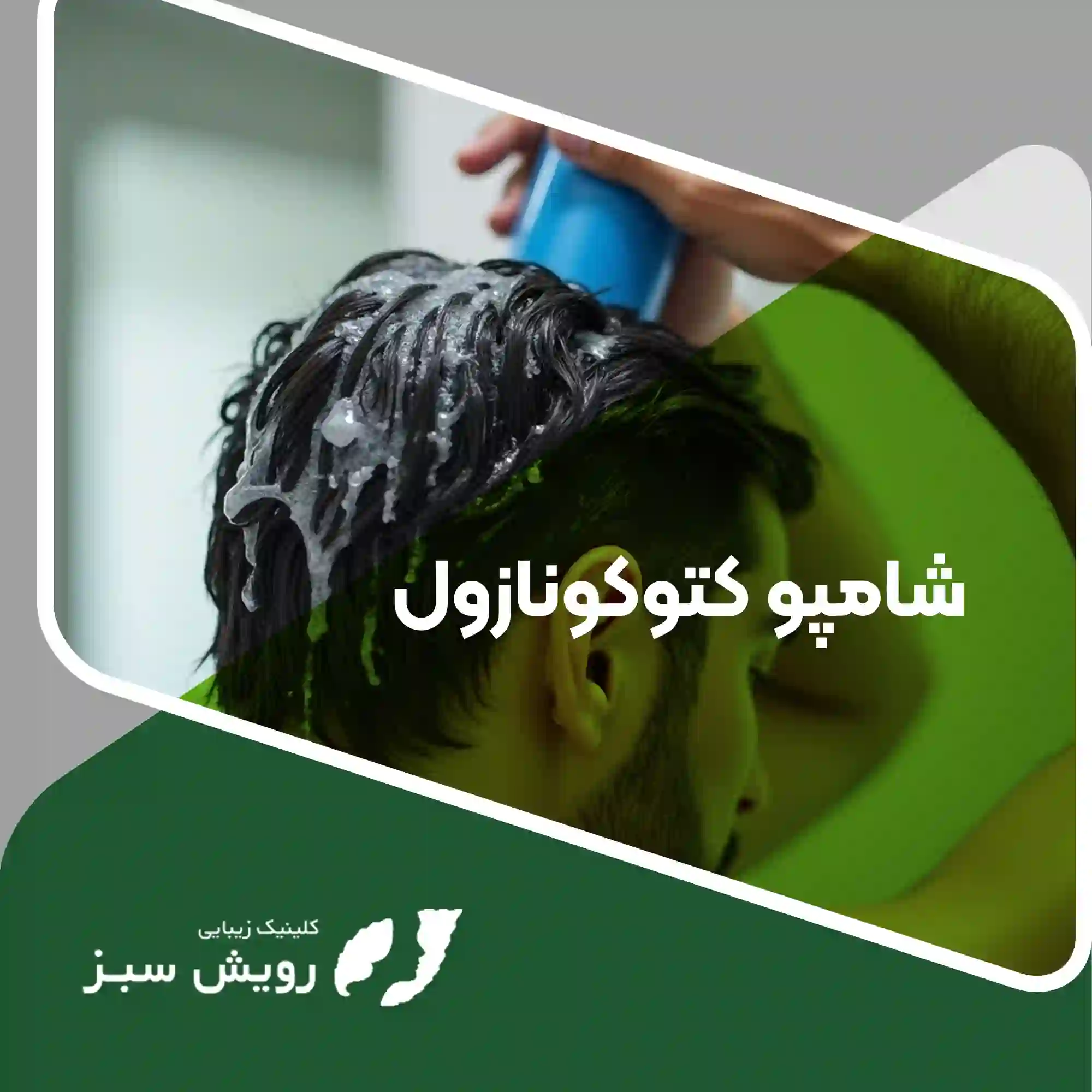 Read more about the article شامپوی کتوکونازول – راهنمای کامل استفاده مزایا و تاثیر آن
