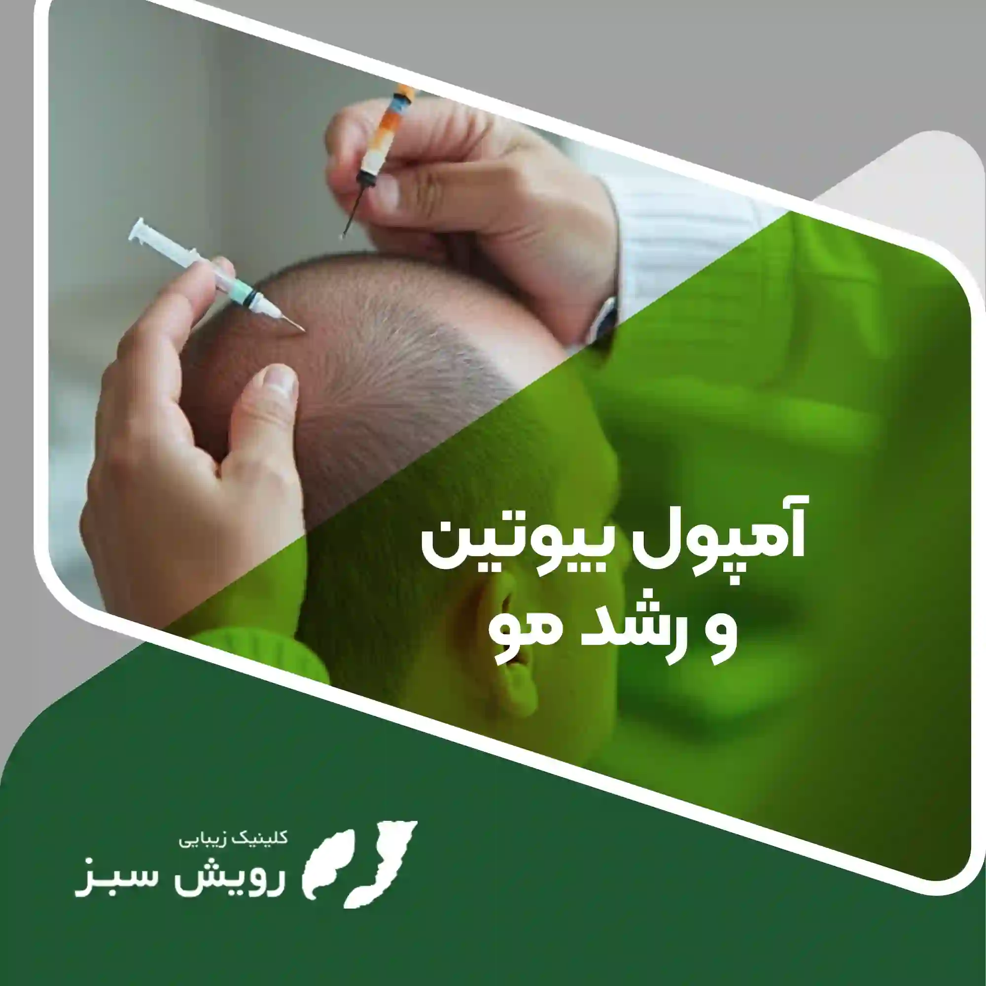 Read more about the article آمپول بیوتین چیست و چرا راهکاری موثر برای جلوگیری از ریزش مو و تقویت موهای کاشته شده است؟