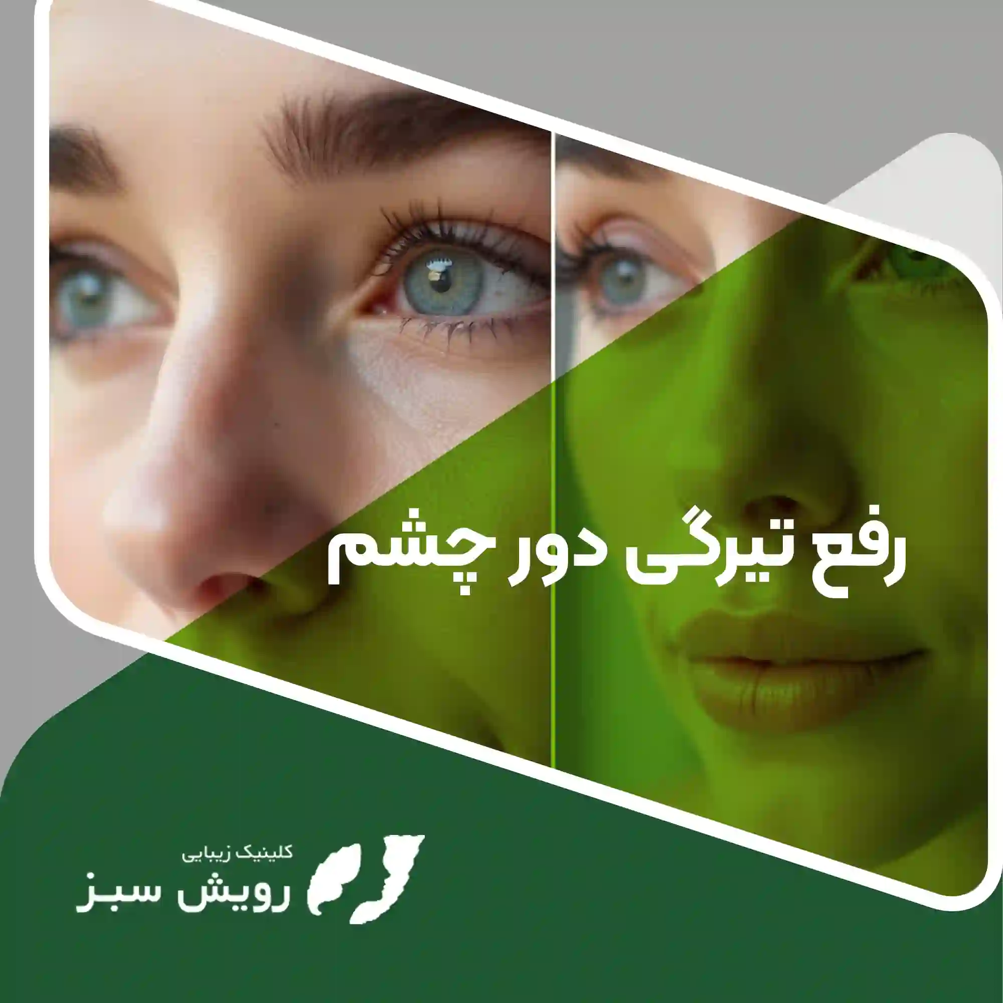 Read more about the article آیا رفع تیرگی دور چشم در سه روز امکان‌پذیر است؟