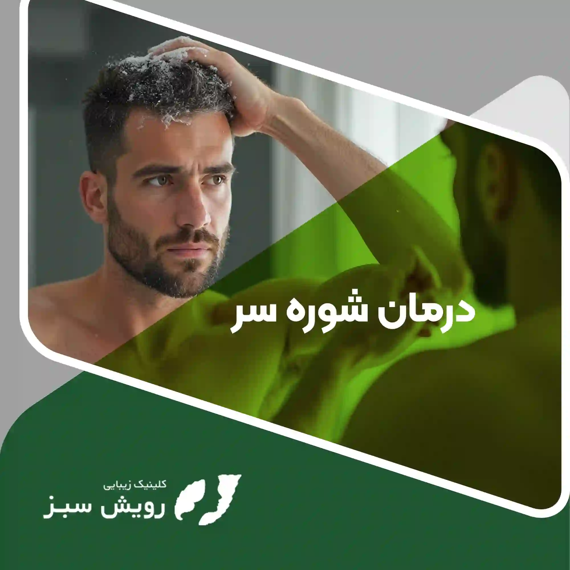 Read more about the article درمان شوره سر – راهکارهای علمی برای جلوگیری از شوره سر