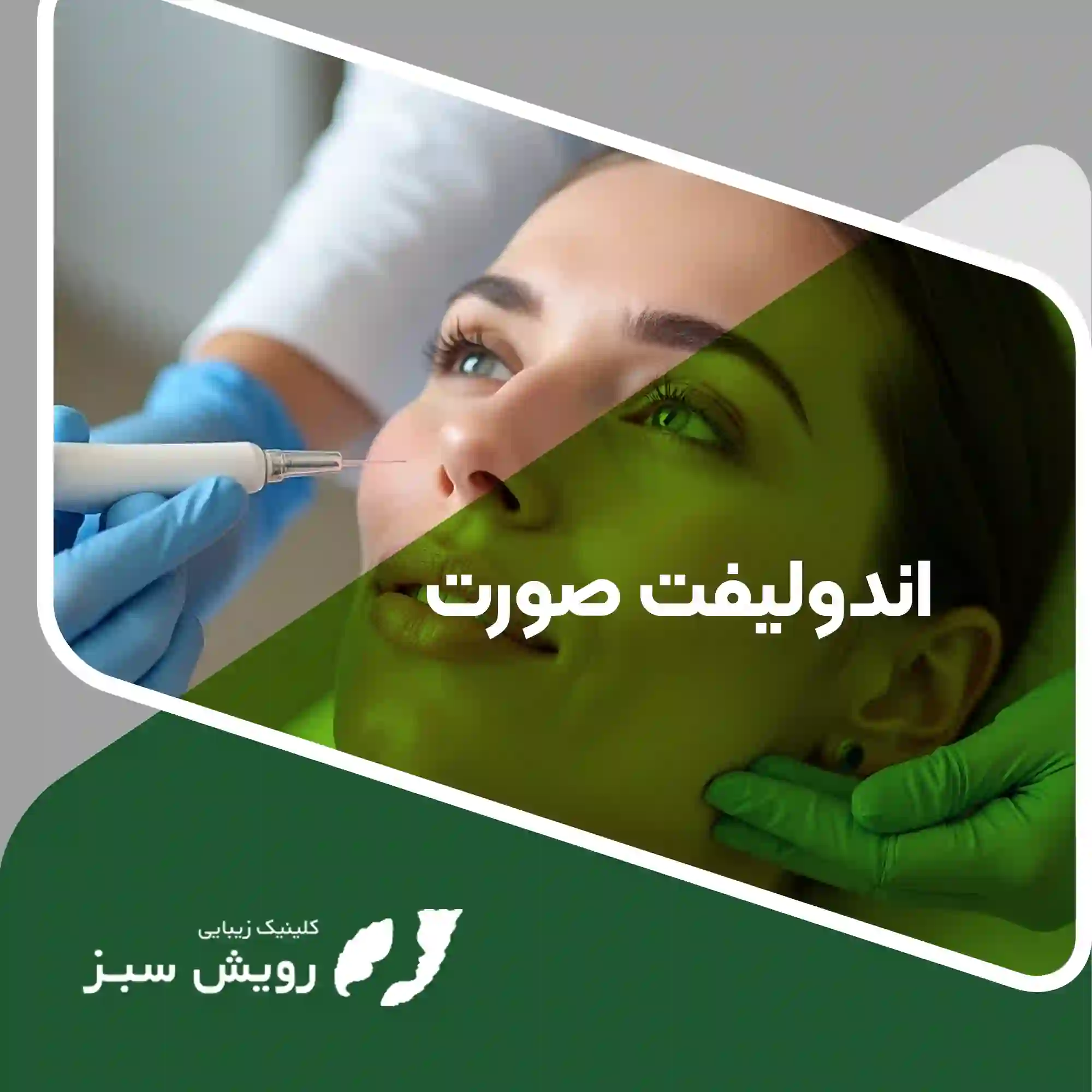 Read more about the article اندولیفت صورت – راهکاری نوین برای لیفت و جوانسازی پوست