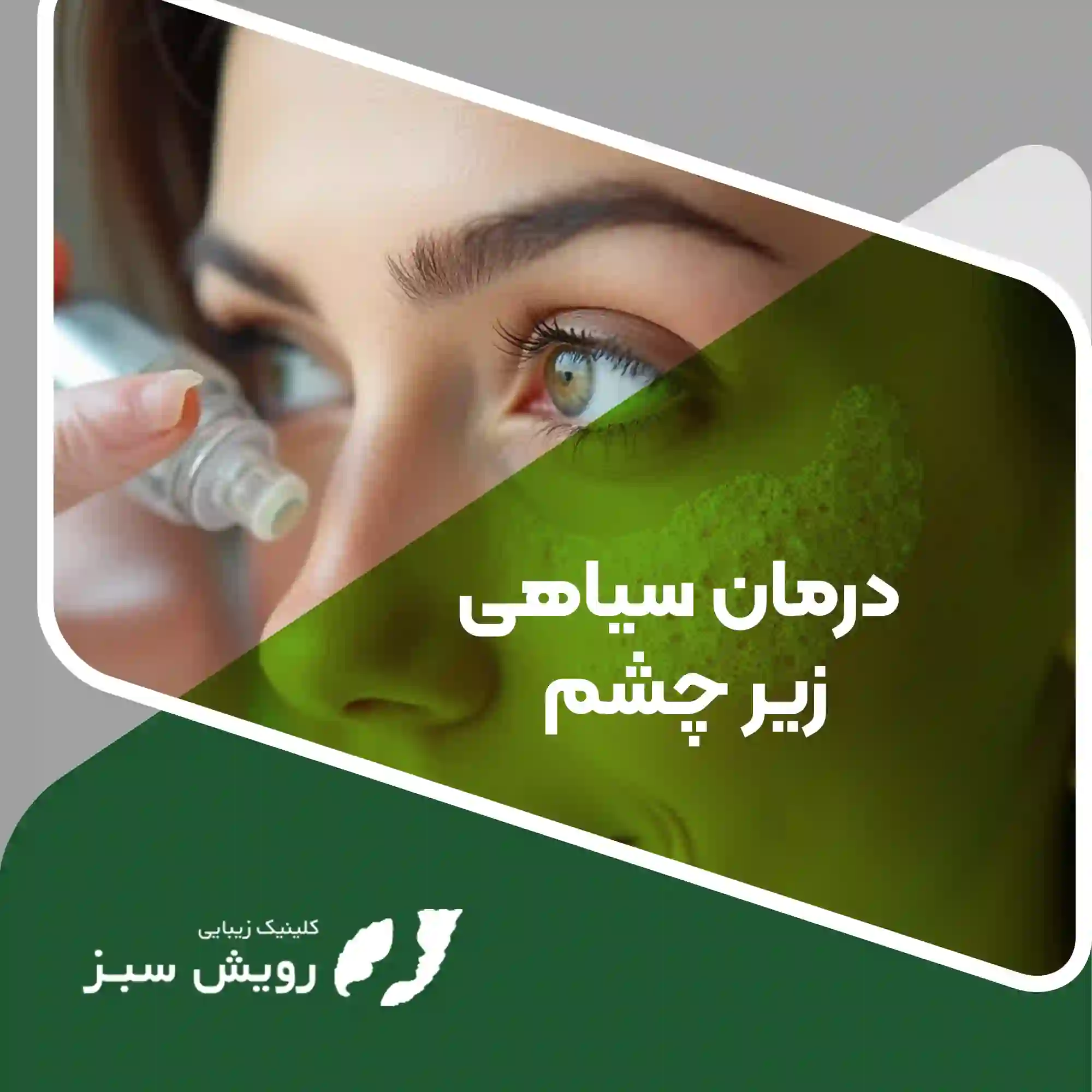 Read more about the article درمان سیاهی زیر چشم –  راهکارهای علمی و تخصصی