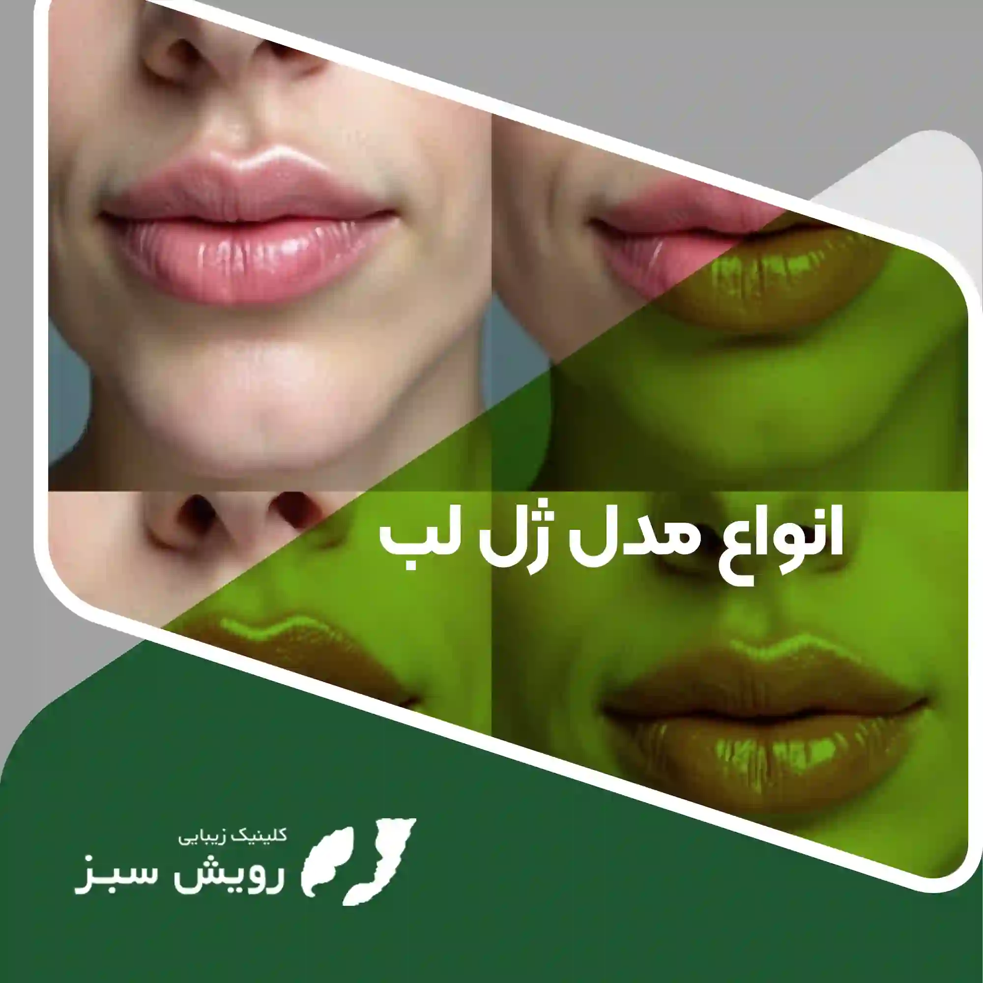 Read more about the article انواع مدل ژل لب – راهنمای کامل انتخاب فرم لب متناسب با چهره