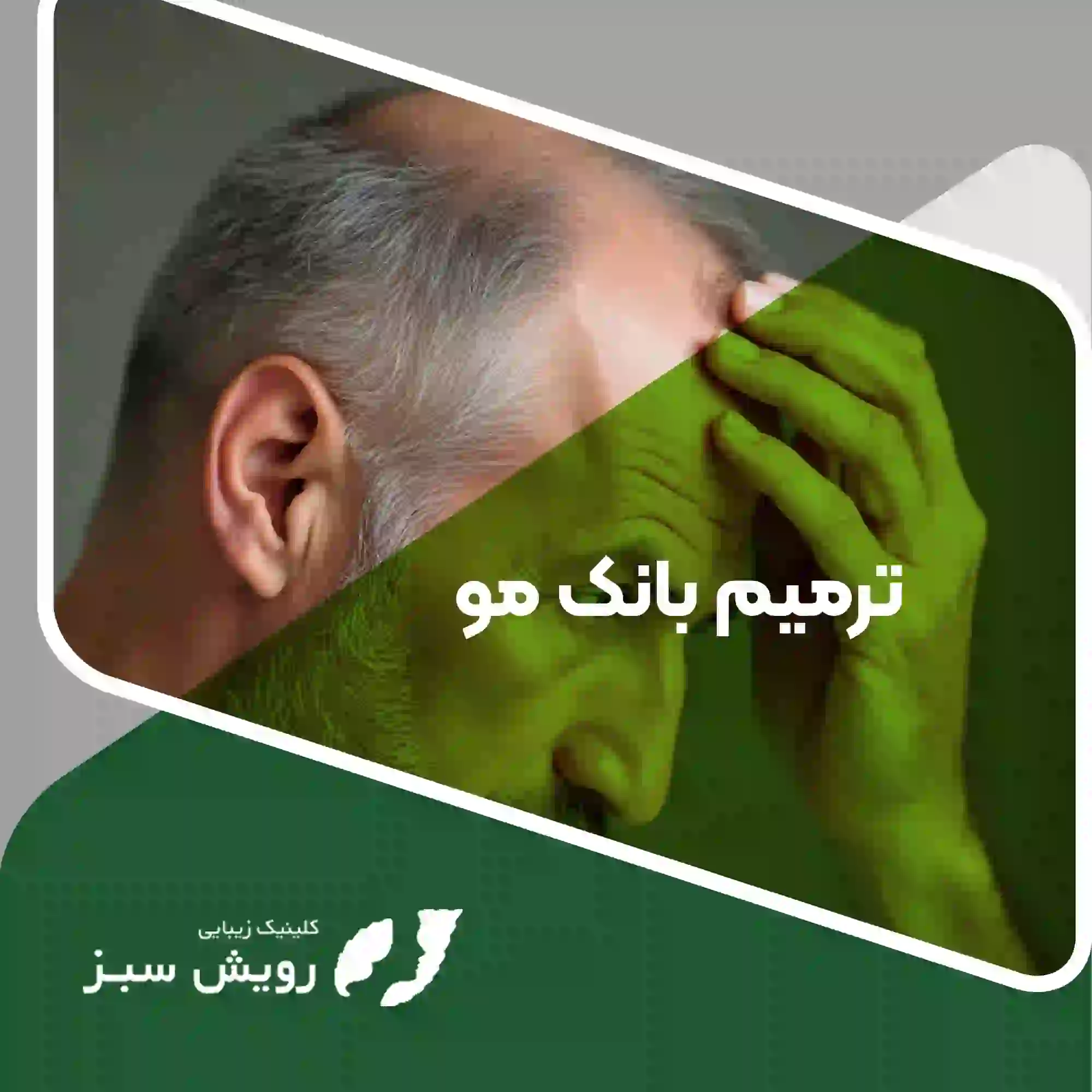 Read more about the article ایا بانک مو ترمیم میشود؟ – راهکارهای ترمیم بانک مو برای کاشت مو