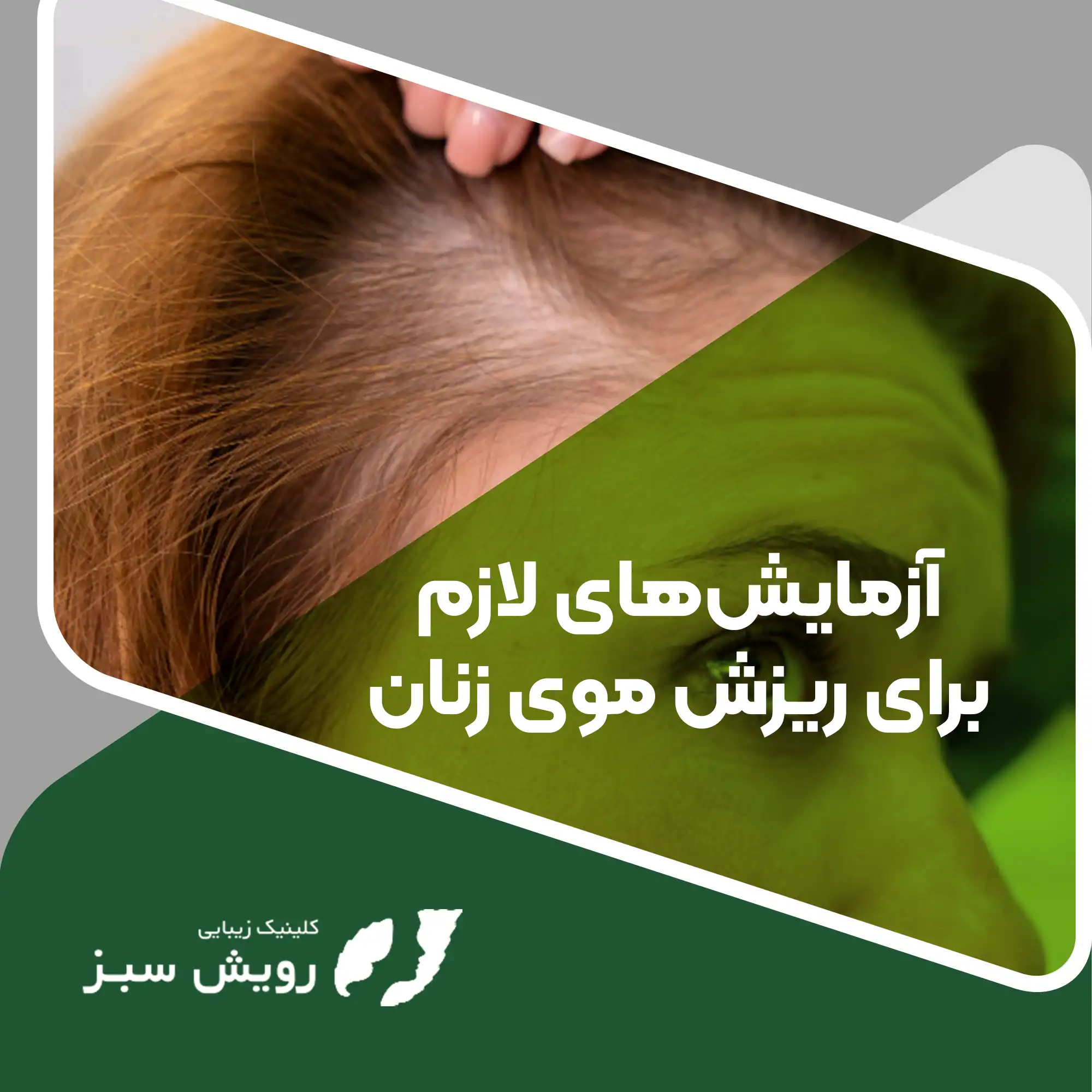Read more about the article آزمایش هورمونی برای ریزش مو در زنان | لیست تمام آزمایش‌های هورمونی مناسب برای ریزش مو در زنان