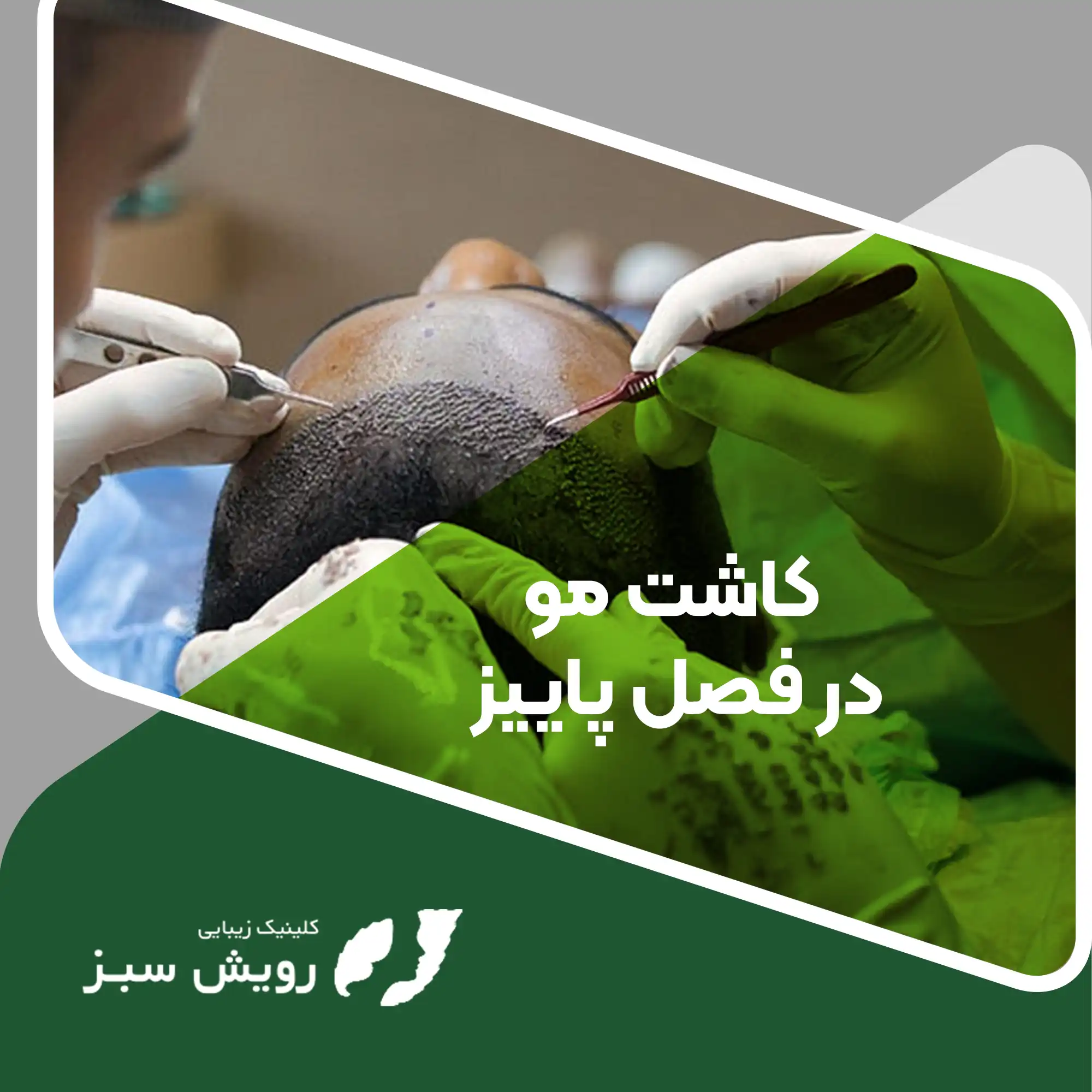 Read more about the article کاشت مو در پاییز چگونه می‌تواند مشکل ریزش موی شما را برای همیشه حل کند؟