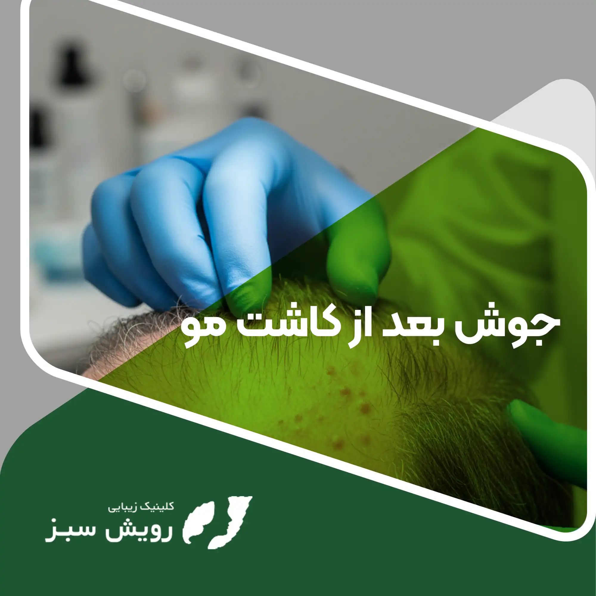 Read more about the article جوش بعد از کاشت مو چیست و چگونه باید با آن برخورد کرد تا به نتیجه نهایی آسیب نرساند