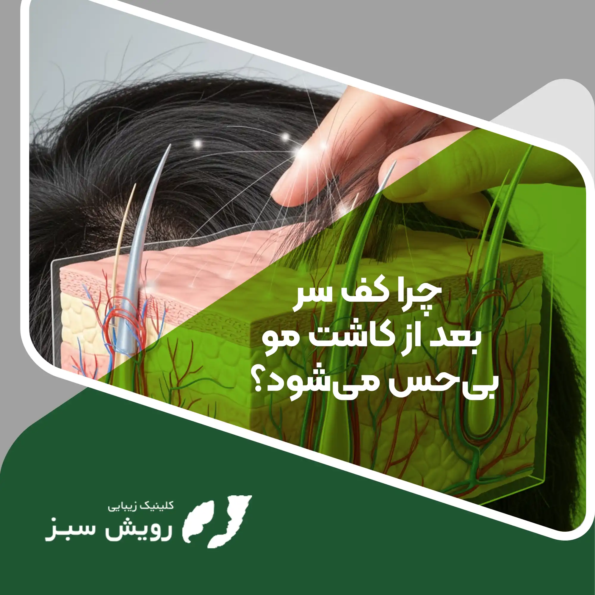 Read more about the article چرا کف سر بعد از کاشت مو بی حس می‌شود؟ کالبدشکافی یک واکنش فیزیولوژیک طبیعی