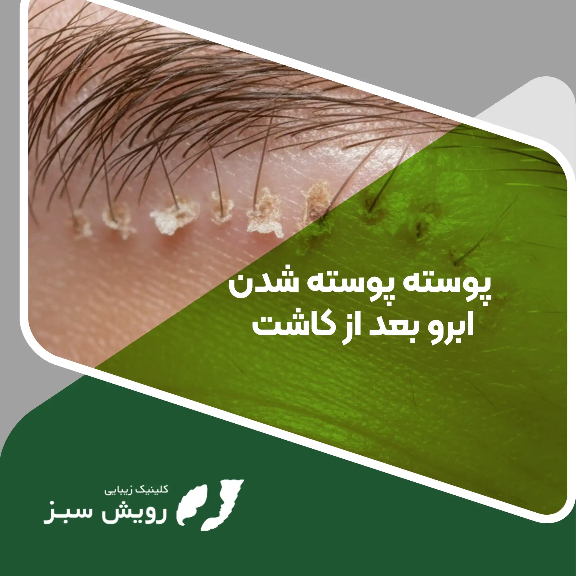 Read more about the article پوسته پوسته شدن ابرو بعد از کاشت؛ نشانه‌ای از بهبودی یا زنگ خطر؟