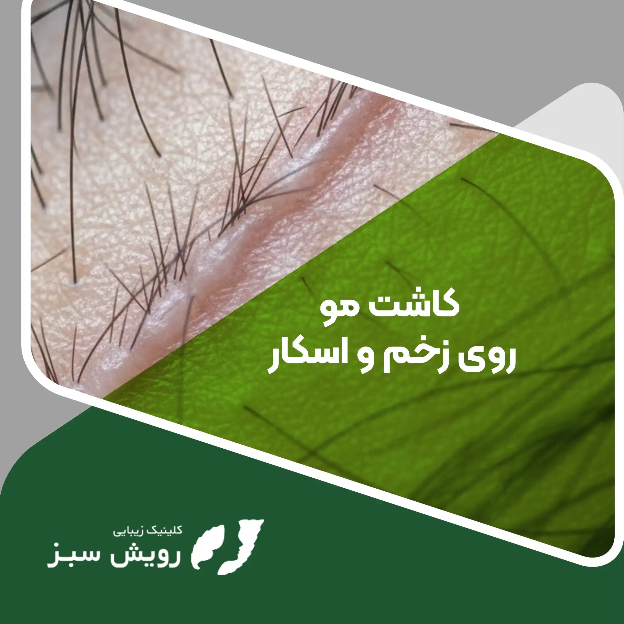 Read more about the article کاشت مو روی زخم و اسکار؛ بازگشت زیبایی به بافت‌های خاموش