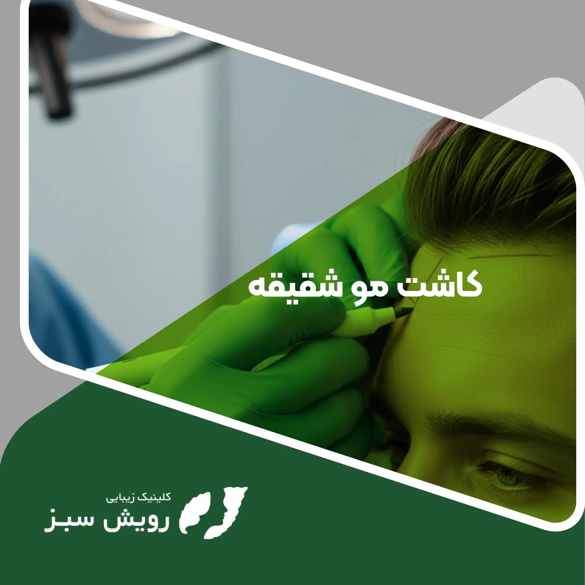 Read more about the article راهنمای کاشت مو شقیقه، تکنیک‌ها مراحل و هزینه