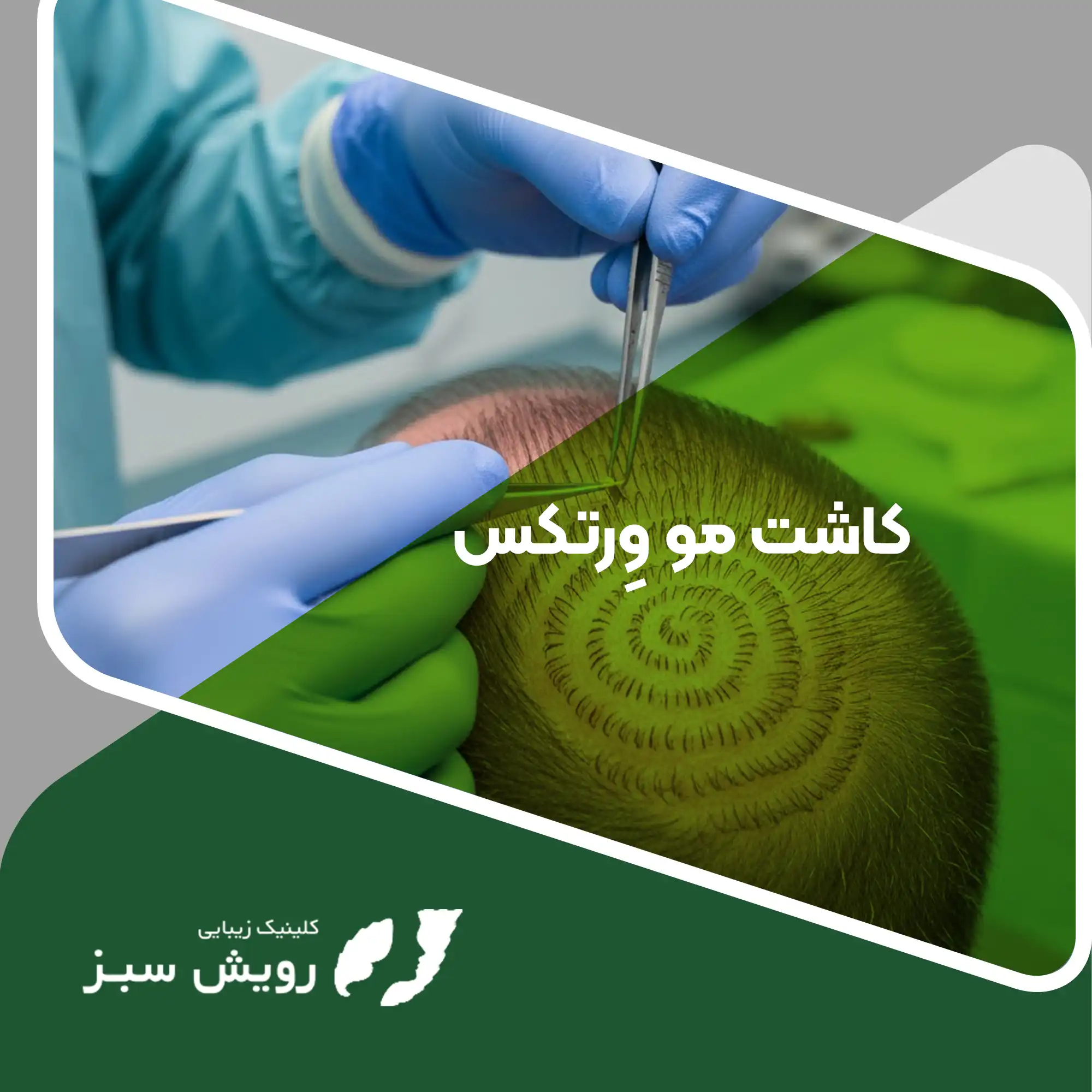 Read more about the article بررسی تخصصی کاشت مو وِرتکس