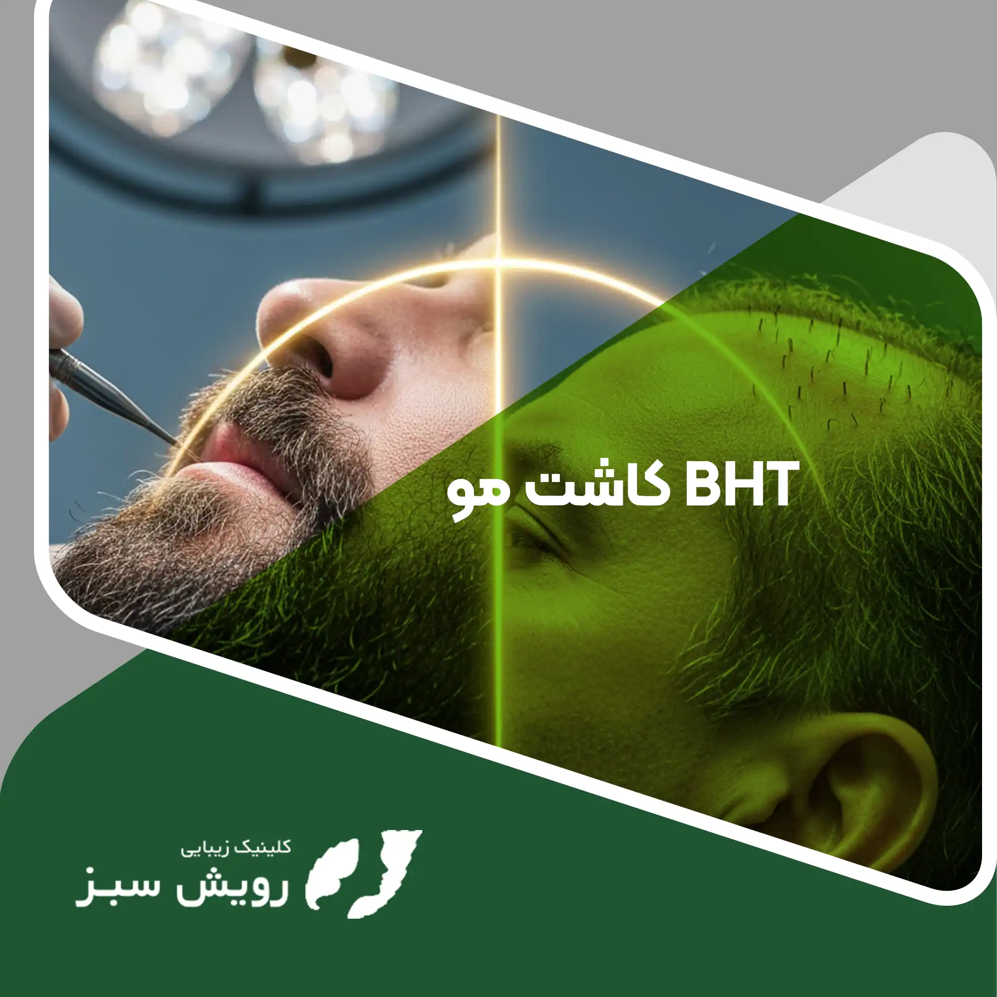Read more about the article بررسی کاشت مو به روش BHT – امید نهایی برای بانک موی ضعیف