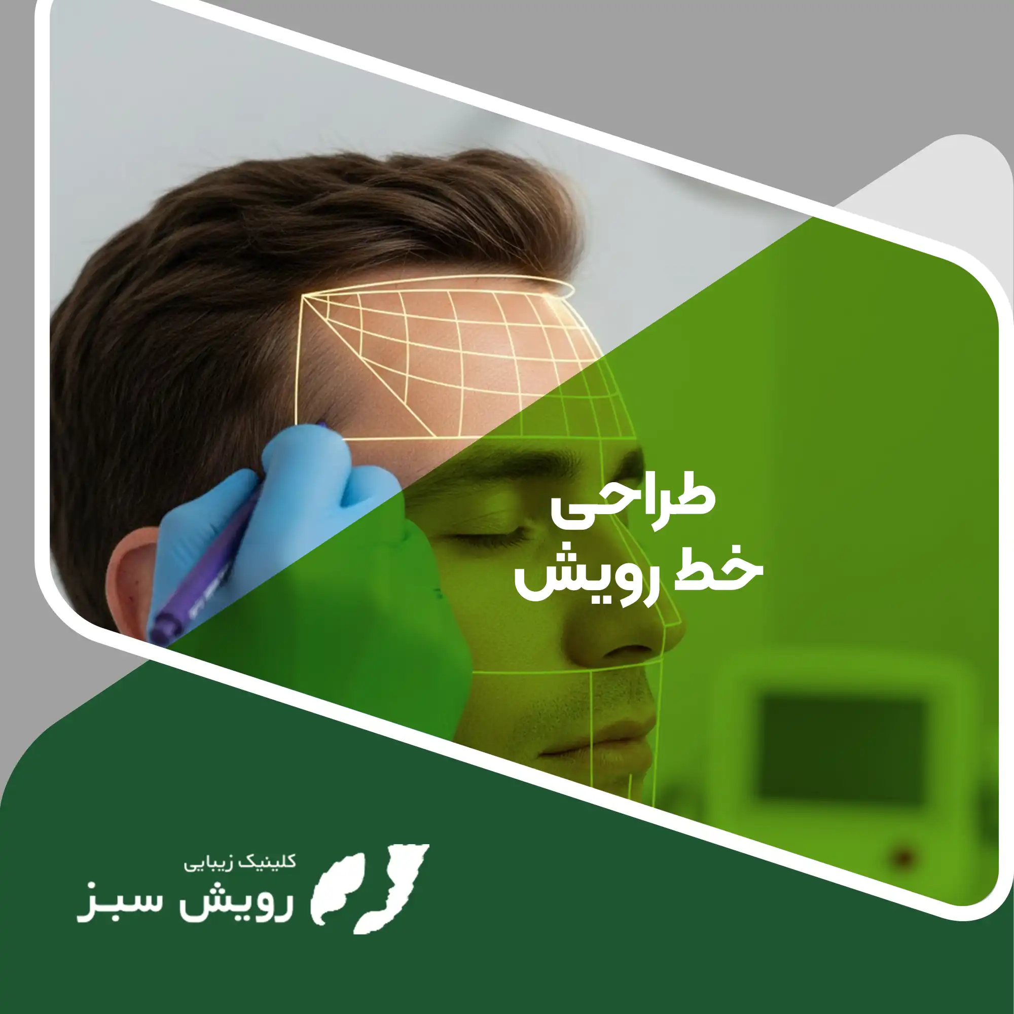 Read more about the article چرا طراحی خط رویش مهم‌ترین بخش کاشت مو است؟