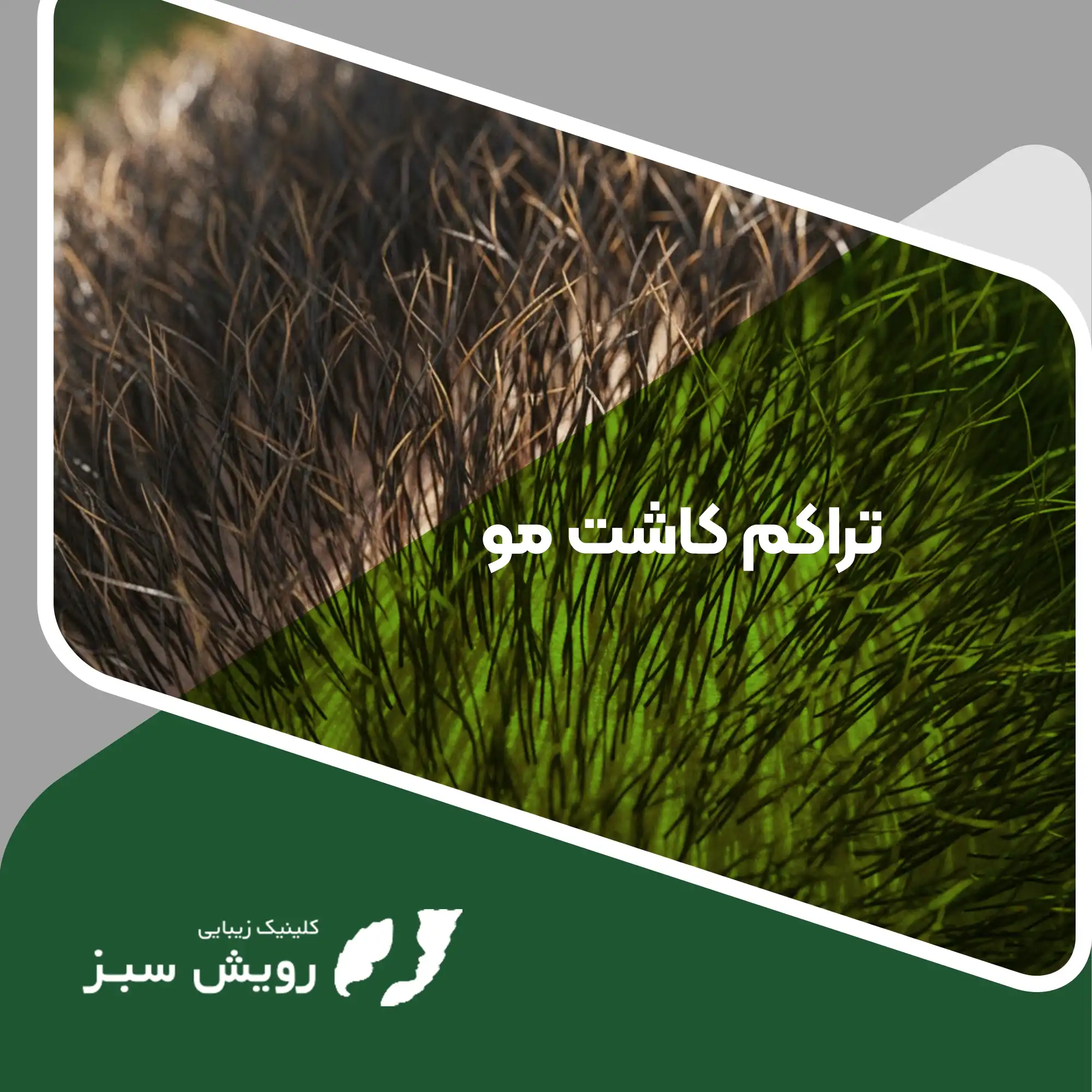 Read more about the article تراکم کاشت مو چقدر میتواند واقعی باشد؟