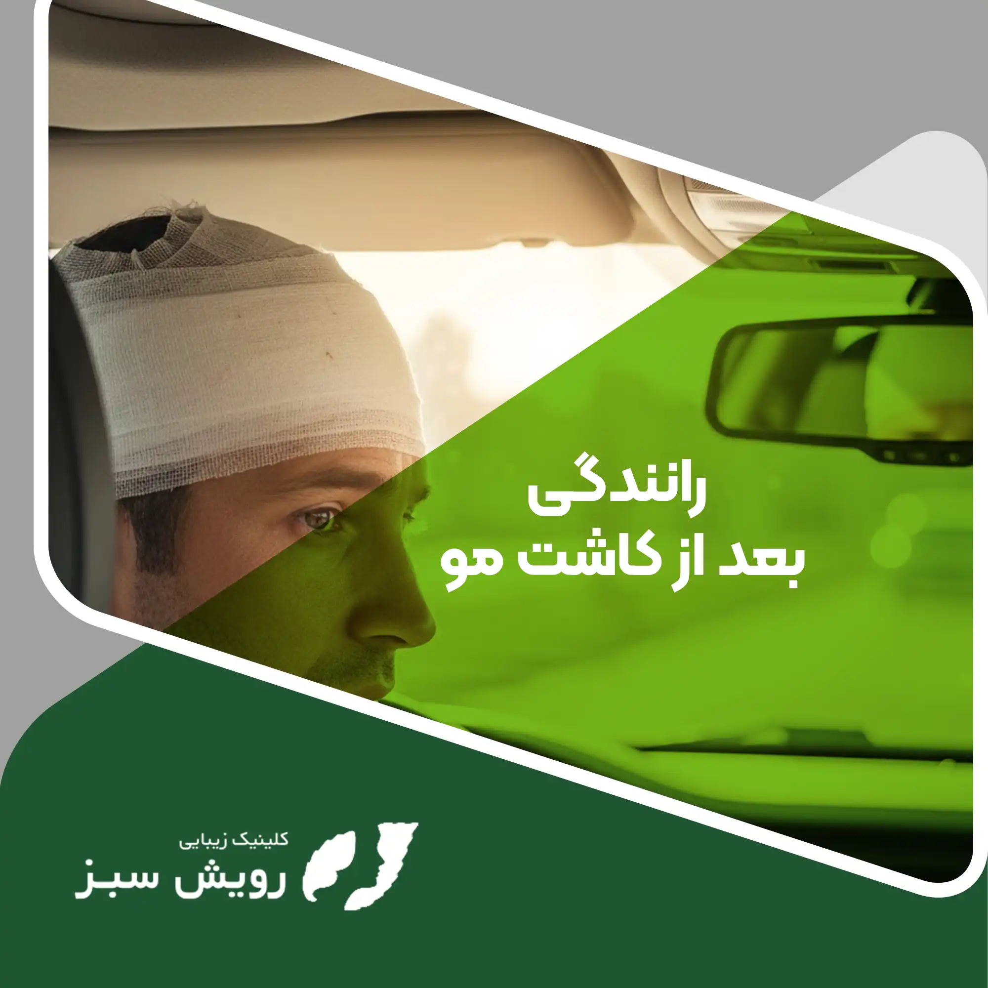 Read more about the article رانندگی بعد از کاشت مو: راهنمای کامل زمان‌بندی و نکات ایمنی
